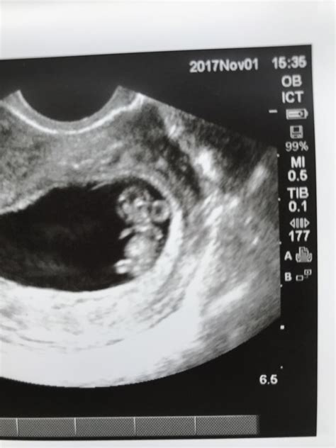 dating ultrasound at 8 weeks